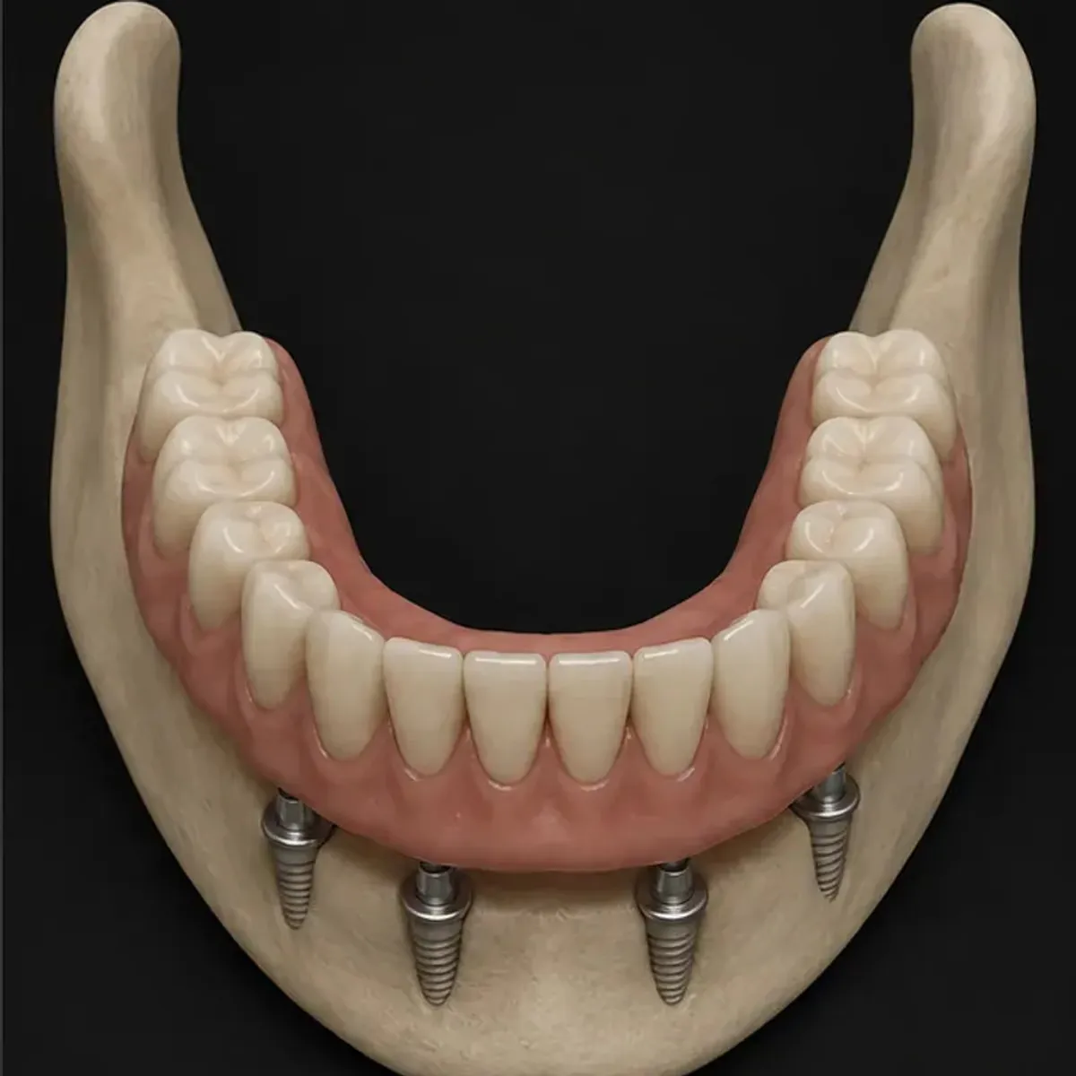 Implant-retained denture result