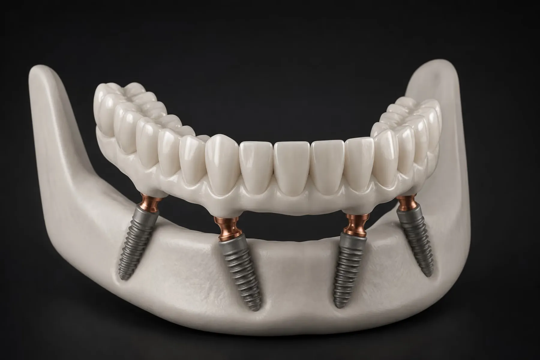 All-on-4 implant bridge
