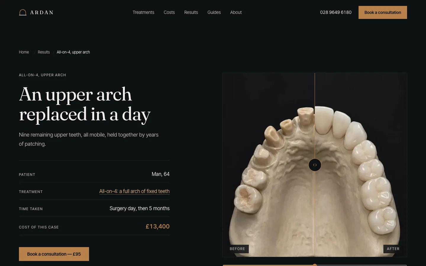 Implant case study
